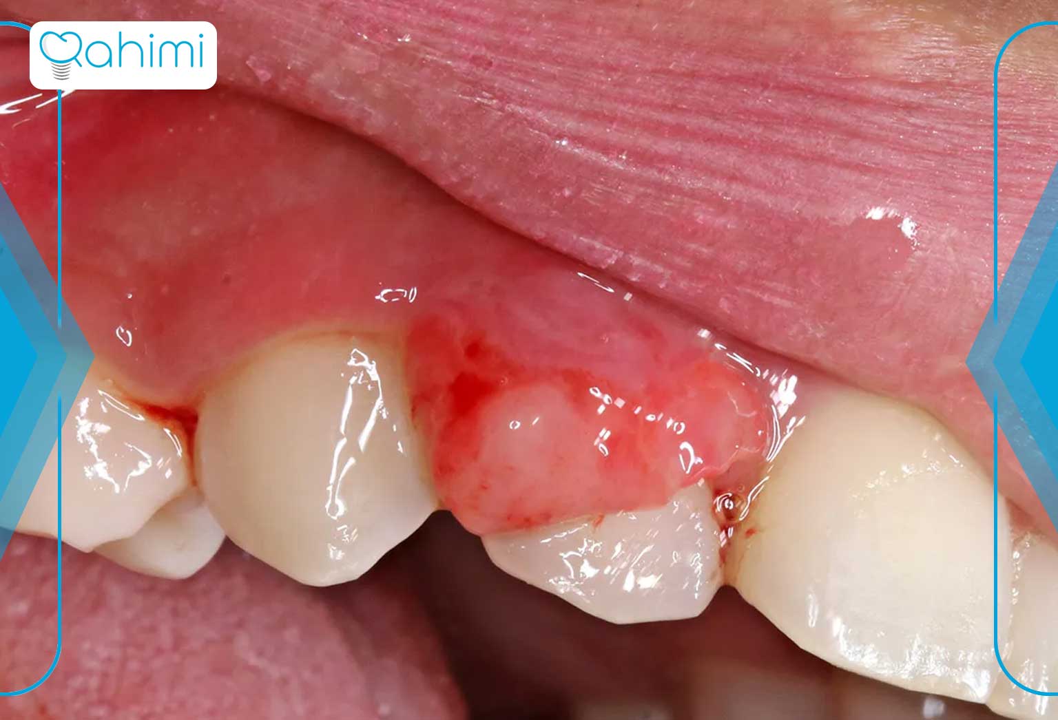 پیشگیری از سرطان لثه