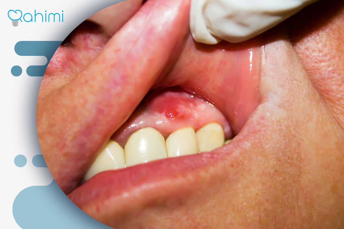 پست و ایمپلنت دندان: پست دندان بهتر است یا ایمپلنت؟ 9 شدت عفونت دندان