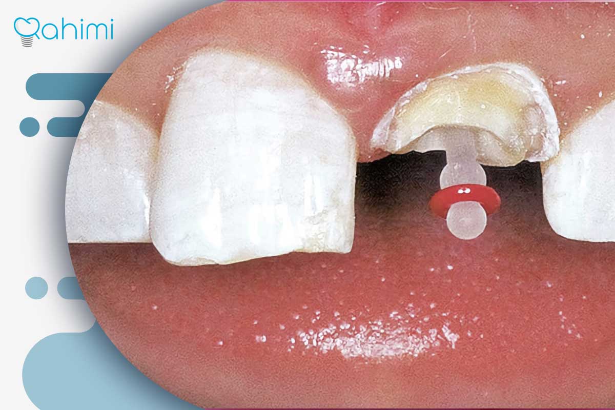 پست و ایمپلنت دندان: پست دندان بهتر است یا ایمپلنت؟ 5 مراحل نصب پست در دندان