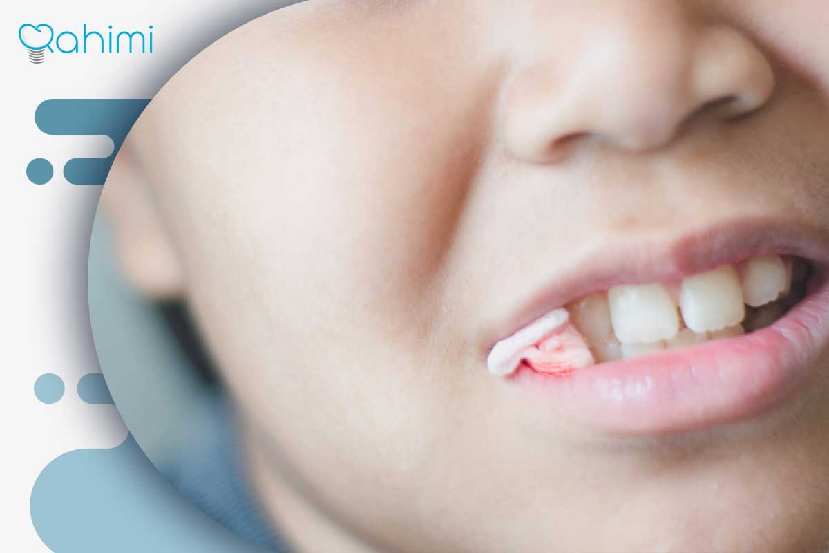 قطع خونریزی لثه