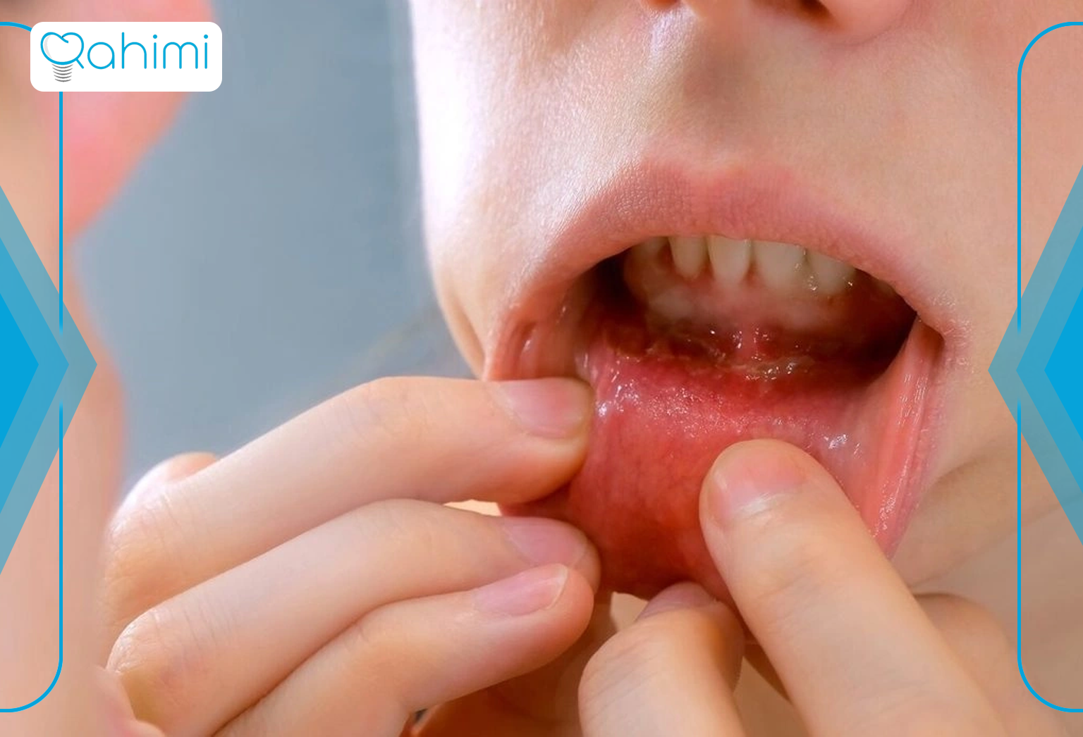 The role of genetics in the occurrence of gum cancer