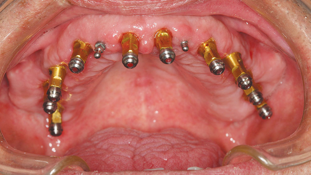 اهمیت انتخاب متخصص ایمپلنت دندان در قم برای درمان موفق (دکتر رحیمی) 11 cm0901 implant treatment planning 20