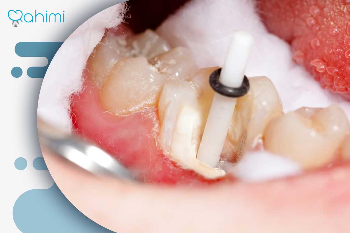 پست و ایمپلنت دندان: پست دندان بهتر است یا ایمپلنت؟ 2 پست دندان