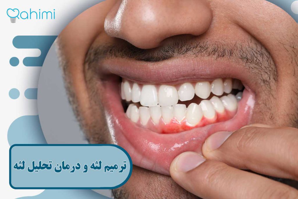 ترمیم لثه