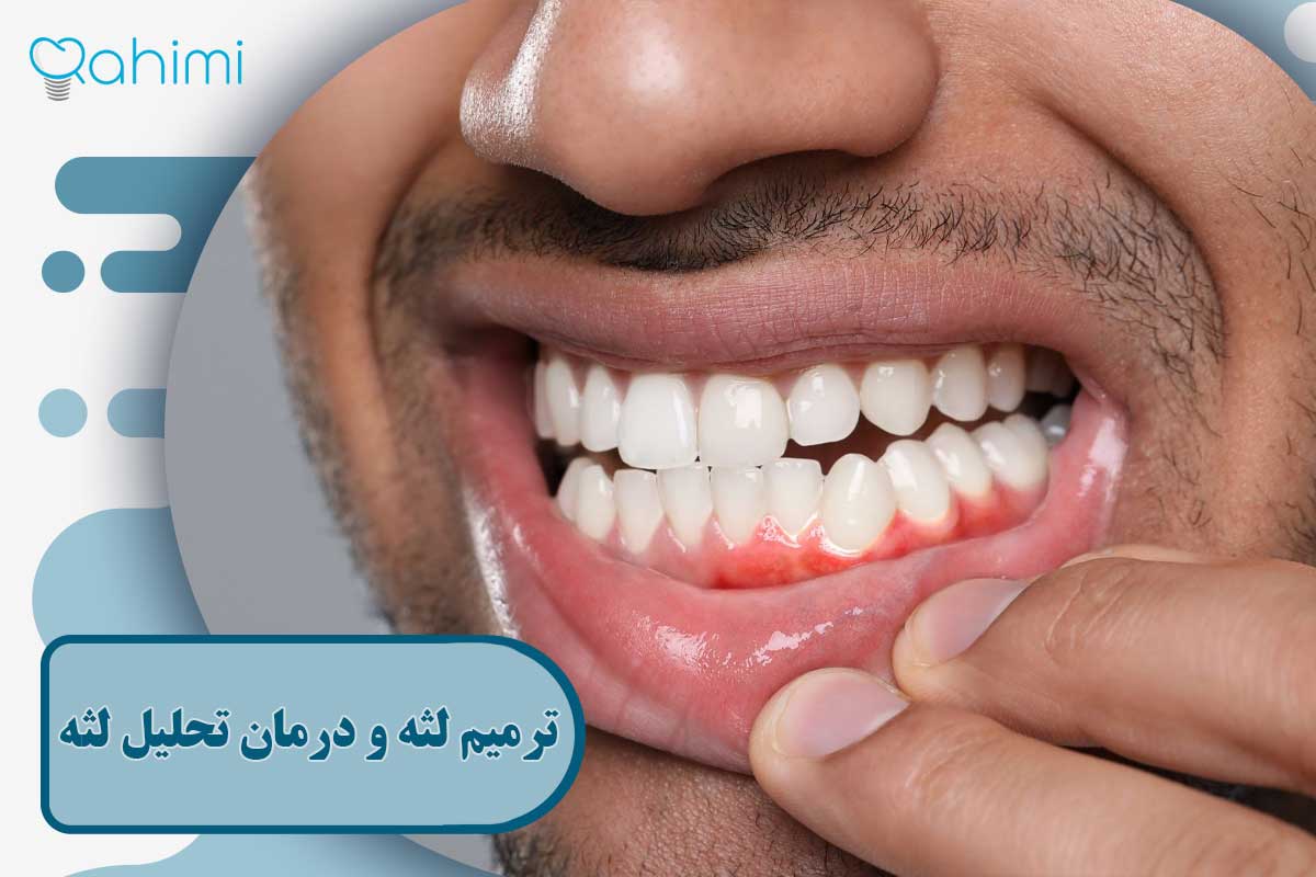 ترمیم لثه و درمان تحلیل لثه؛ علائم، علتها و روشهای جراحی و غیرجراحی 3 ترمیم لثه