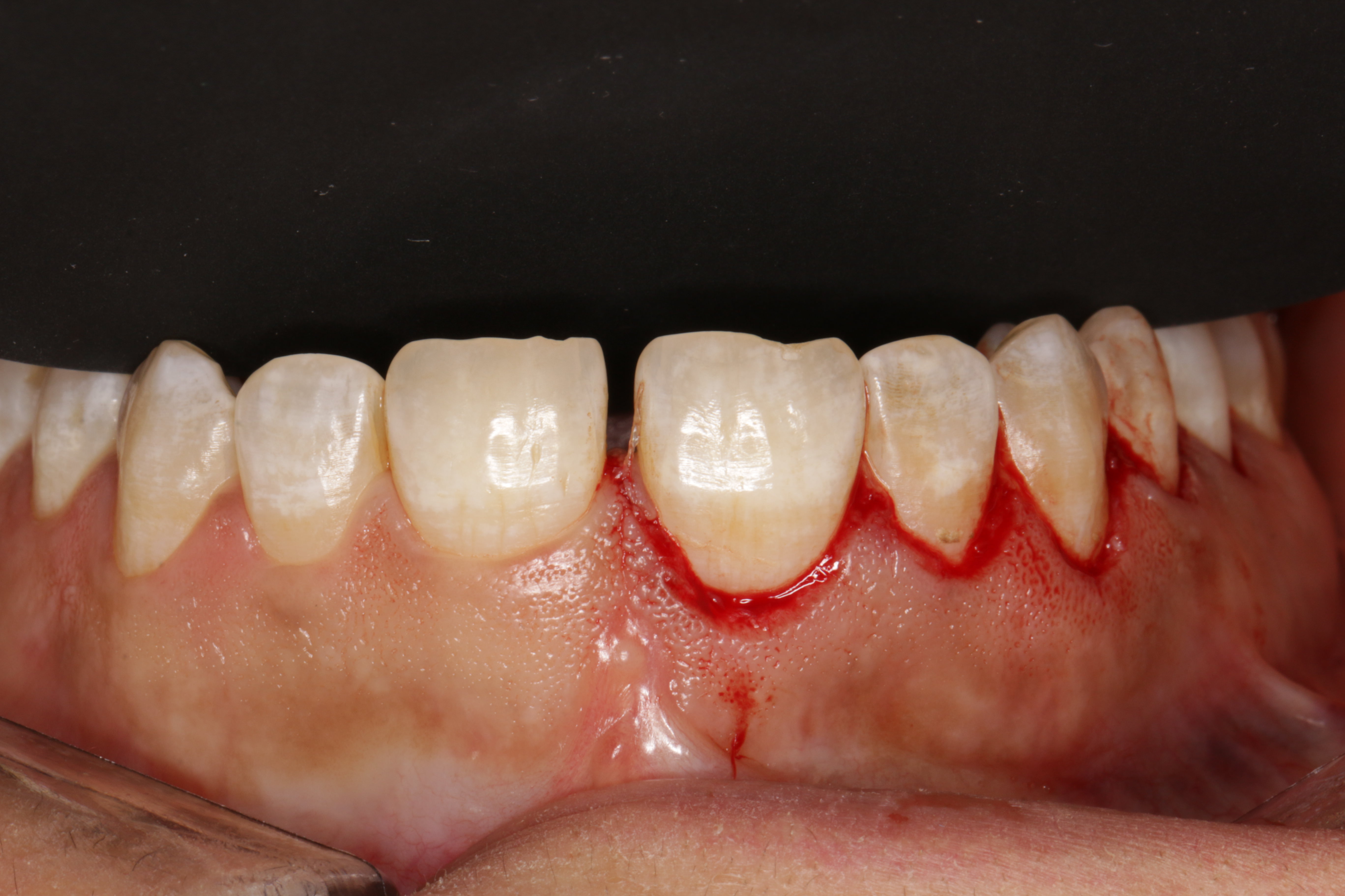 اهمیت انتخاب متخصص ایمپلنت دندان در قم برای درمان موفق (دکتر رحیمی) 8 implant 4