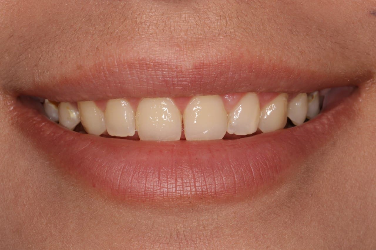 اهمیت انتخاب متخصص ایمپلنت دندان در قم برای درمان موفق (دکتر رحیمی) 5 implant1