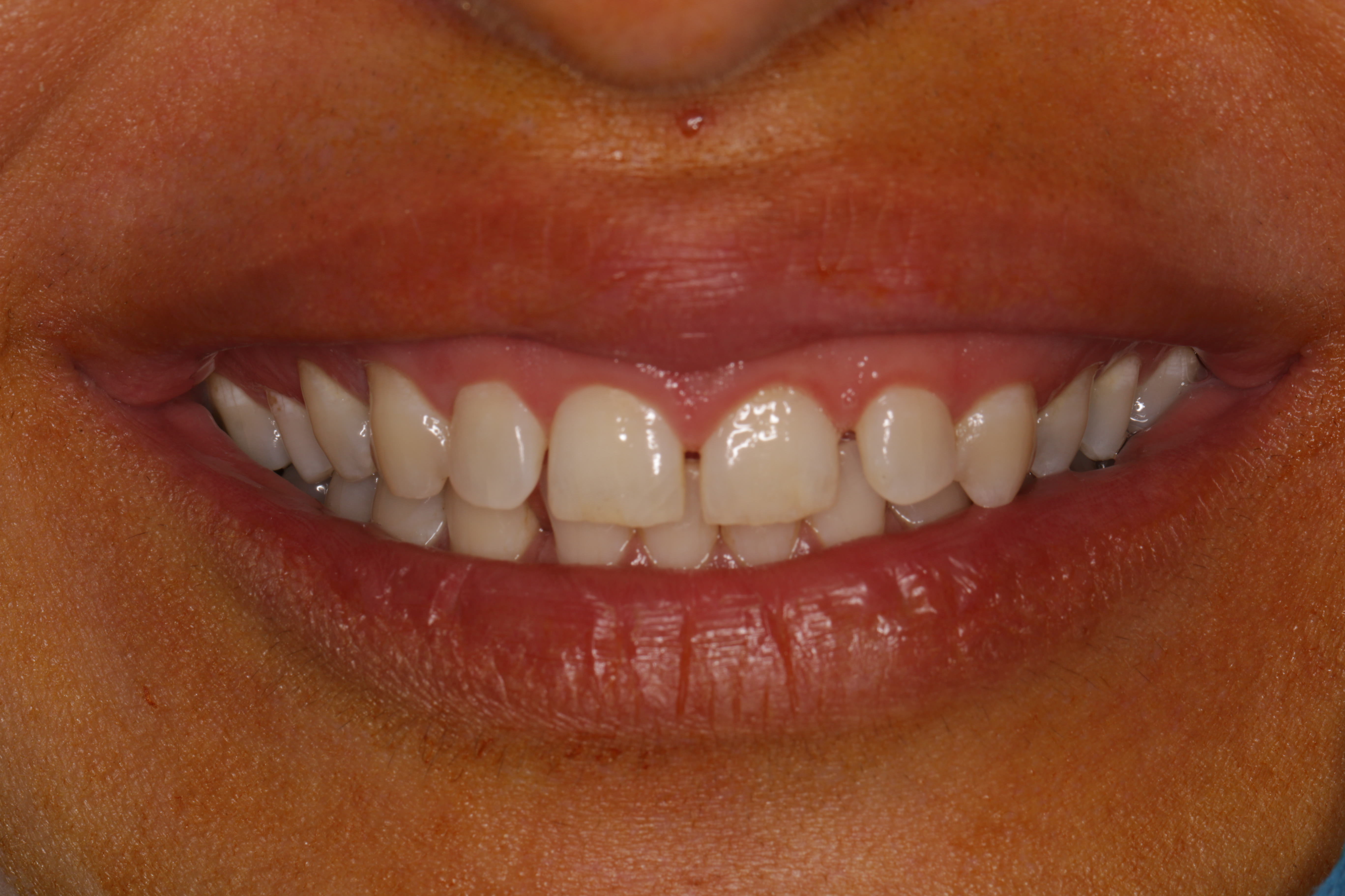 اهمیت انتخاب متخصص ایمپلنت دندان در قم برای درمان موفق (دکتر رحیمی) 3 implant3