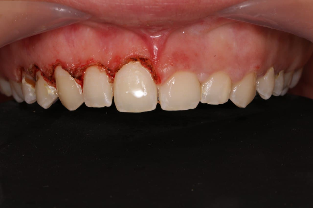 اهمیت انتخاب متخصص ایمپلنت دندان در قم برای درمان موفق (دکتر رحیمی) 6 implant5