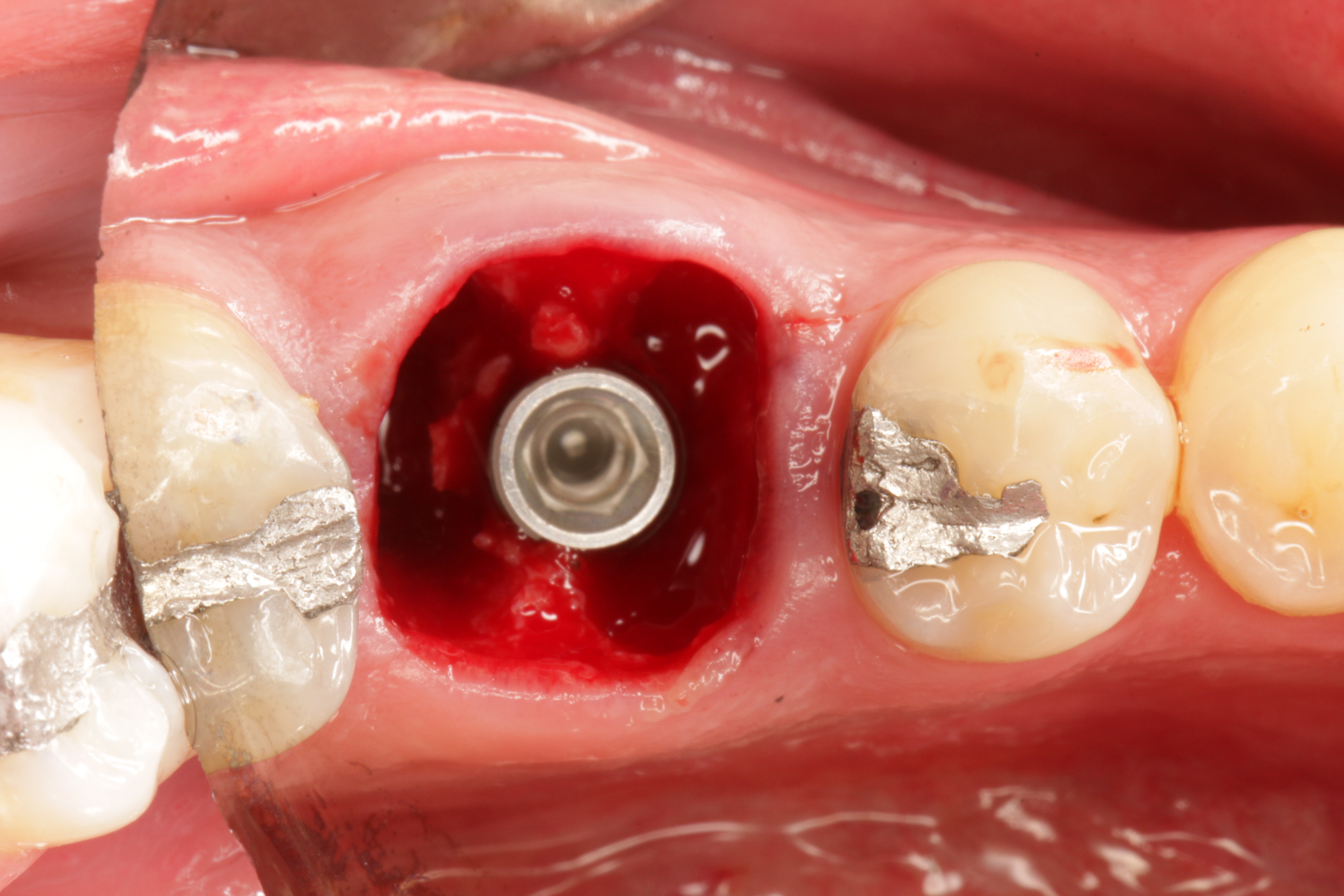 اهمیت انتخاب متخصص ایمپلنت دندان در قم برای درمان موفق (دکتر رحیمی) 7 implant6