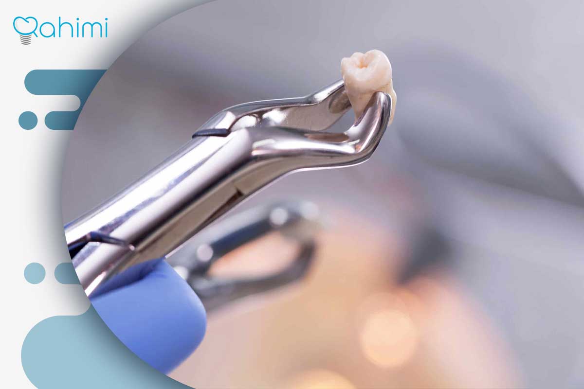 کشیدن دندان با لیزر؛ روش انجام، مزایا، کاربردها و مراقبتهای پس از درمان 1 The difference between tooth extraction with traditional and laser methods