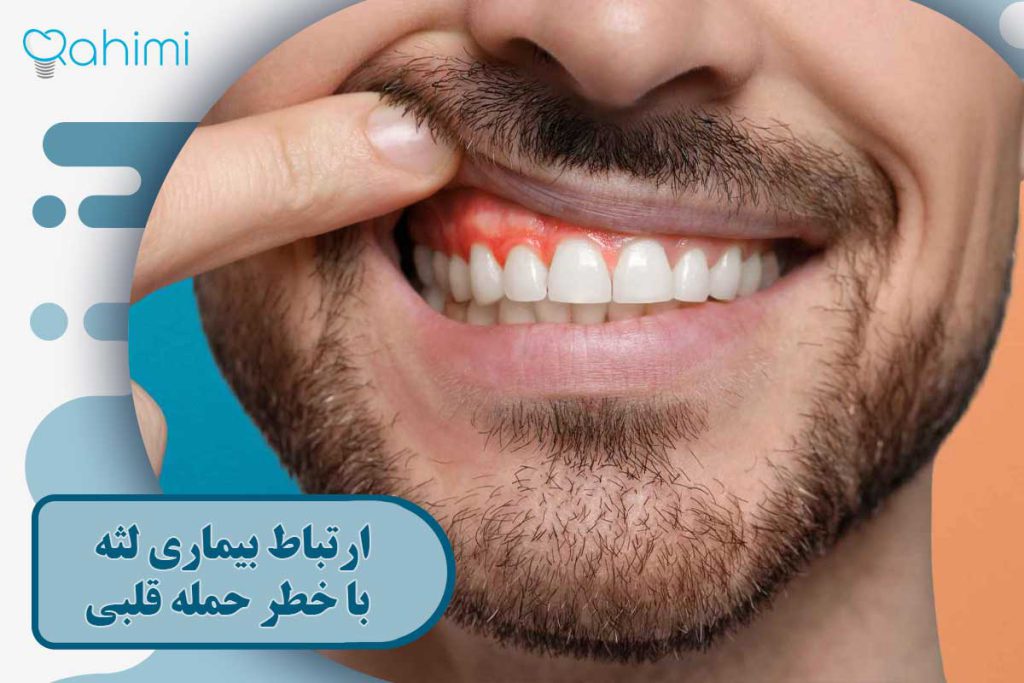 ارتباط بیماری لثه با خطر حمله قلبی