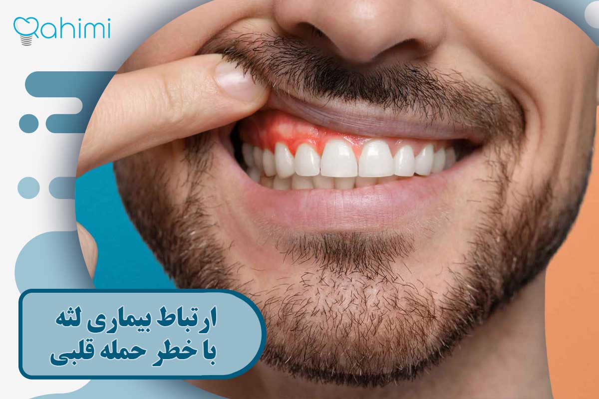 ارتباط بیماری لثه با خطر حمله قلبی