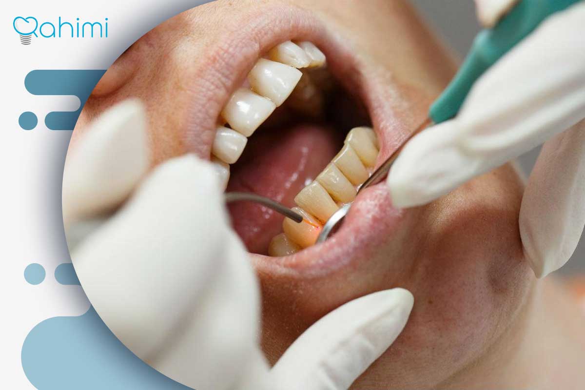 ارتباط بیماری لثه با خطر حمله قلبی: علائم هشدار و راهنمای پیشگیری 3 درمان بیماری لثه