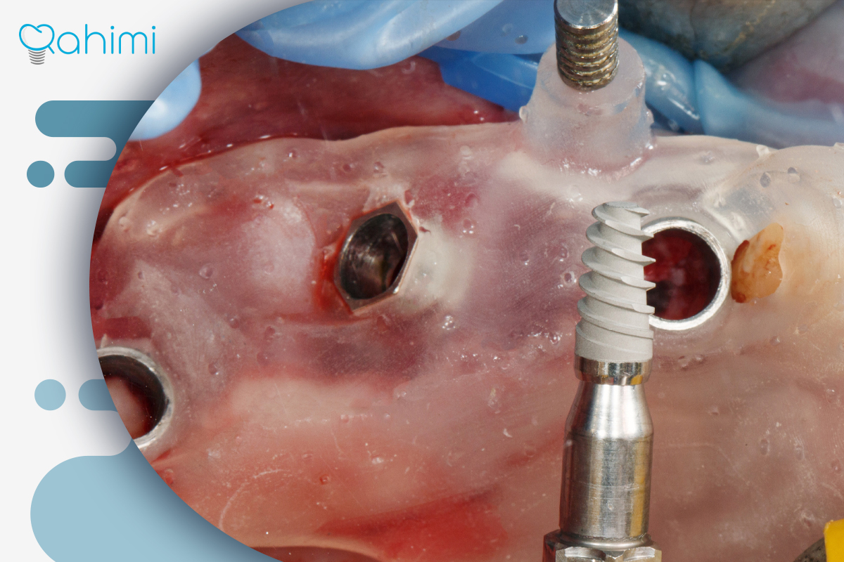 بهترین روش کاشت ایمپلنت دندان در کلینیک دکتر رحیمی: مراحل، مزایا و توصیههای حرفهای 6 Different implant placement methods