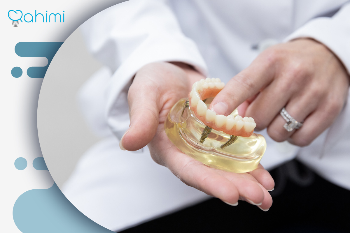بهترین روش کاشت ایمپلنت دندان در کلینیک دکتر رحیمی: مراحل، مزایا و توصیههای حرفهای 4 Types of dental implant placement methods