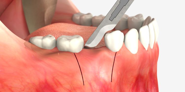 csm sequence implant