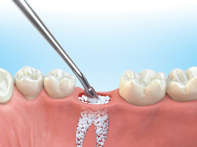 easy graft compressing into defect 640x480 1