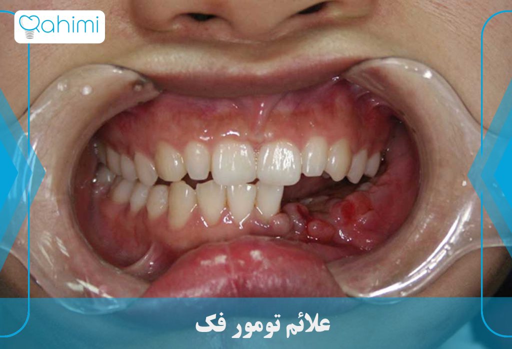 11 نشانه اصلی سرطان فک چیست؟ 10 علائم تومور فک