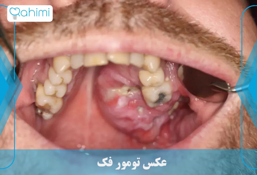 11 نشانه اصلی سرطان فک چیست؟ 11 عکس تومور فک