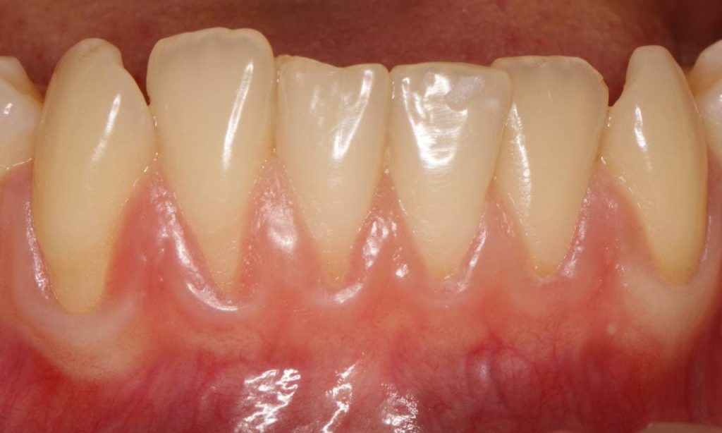 implant2