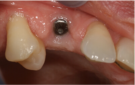 single tooth implant before after greenwich